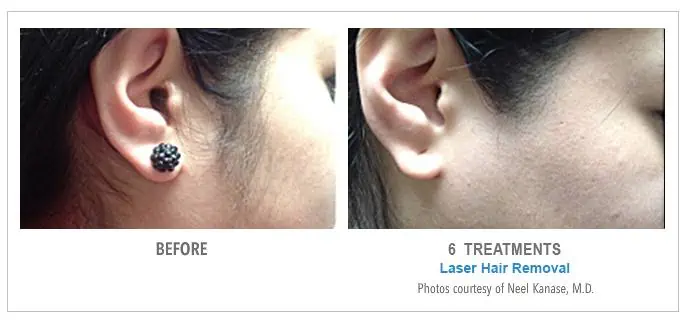 Sideburns Laser Hair Removal Before and After